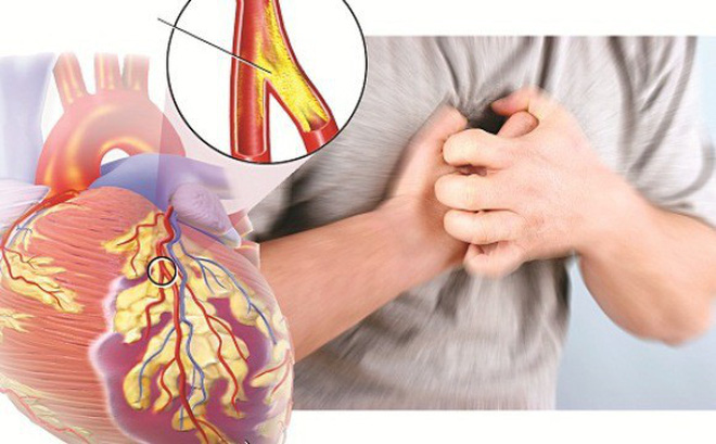 Cả đời không lo mắc các bệnh mạch vành chỉ nhờ 5 bước đơn giản sau đây